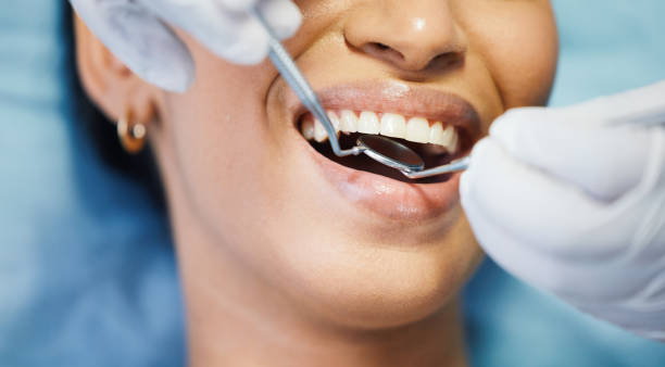 Teeth Whitening in LA