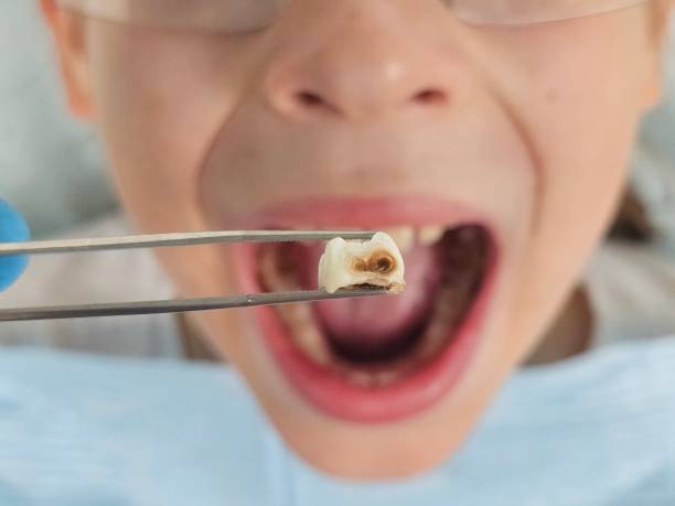 Best Tooth Infection Emergency Dentist  in Campti, LA