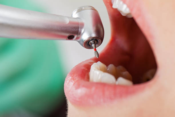 Best Root Canal Emergency Dentist  in Campti, LA